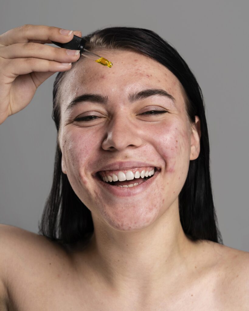 como eliminar el acne definitvamente