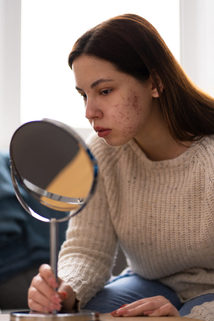 que hacer con el acne hormonal en adultos